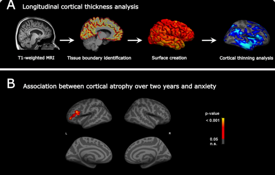 J Neuroinflammation | 使用MRI，TMS- EEG及基于个体头模的源端脑网络探索多发性硬化症并发的焦虑症状